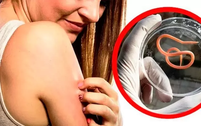 a testben lévő paraziták okozta viszketés és irritáció