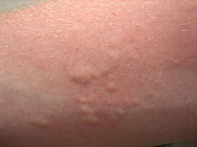 a viszkető allergiás bőrkiütések az ascariasis tünetei lehetnek