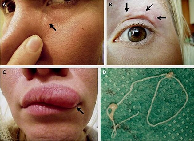 A dirofilariasis fő megnyilvánulásai az arcon